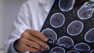 Doctor examining MRI images of patient with multiple sclerosis in clinic, closeup