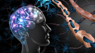 Multiple sclerosis nerve disorder and damaged myelin or MS autoimmune disease with healthy nerve with exposed fibre with scarrred cell sheath loss with 3D illustration elements.