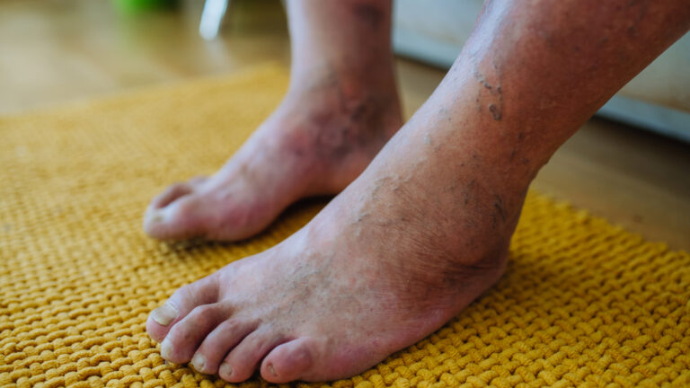 A close-up shot of man's feet with diabetic foot complication.