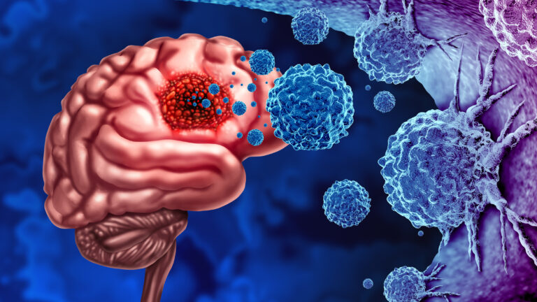 Glioma Cancer Tumor as malignant cells outbreak as a brain disease attacking neurons as a medical concept of neurological disease with 3D illustration elements.